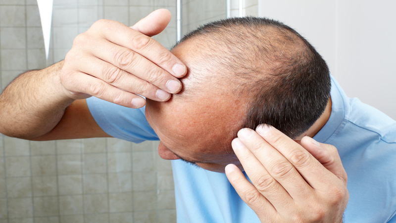 Tackle Hair Loss in Texas Head on