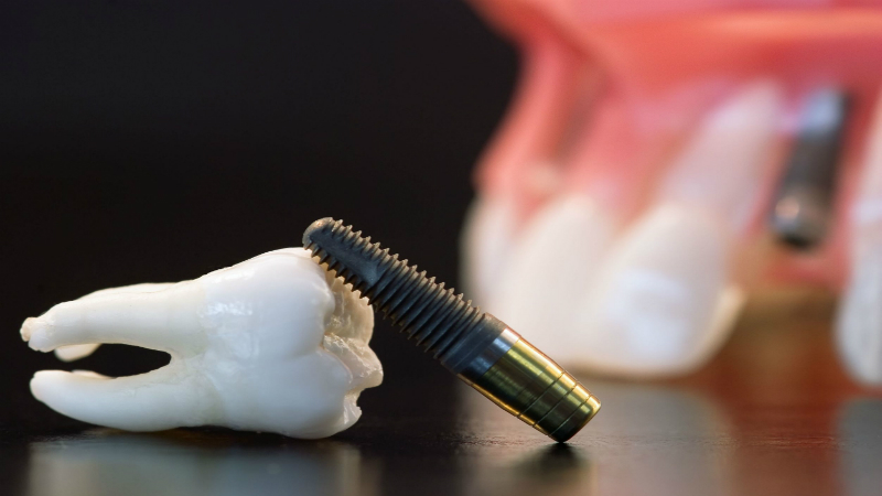 What to Know About Dental Implants in Doral